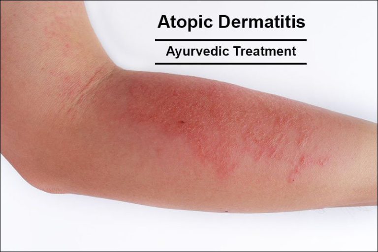 How to Treat Atopic Dermatitis in Ayurveda Naturally?