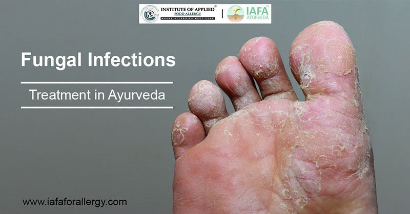 Treatment of Fungal Infections in Ayurveda