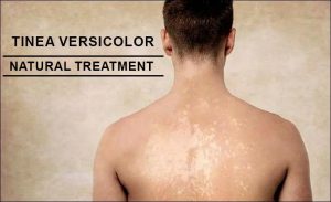 Natural Treatment For Tinea Versicolor - Safest Way To Heal It