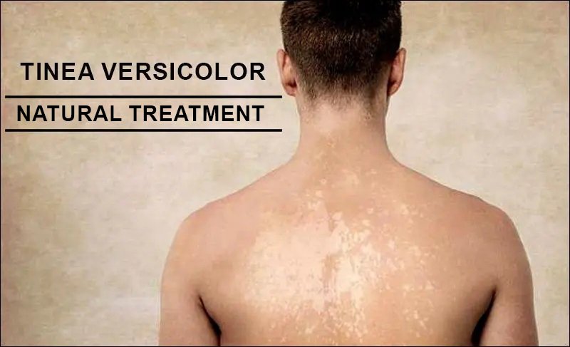 Tinea Versicolor or An-An: Types, Causes, Prevention, Cure