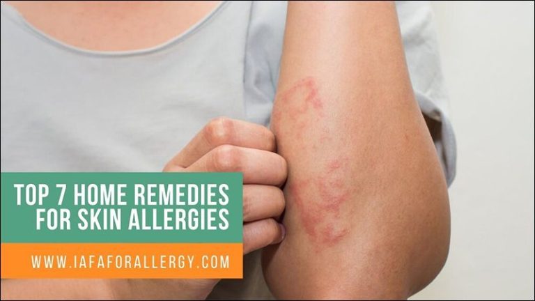 top-7-home-remedies-for-skin-allergies-ayurvedic-treatment