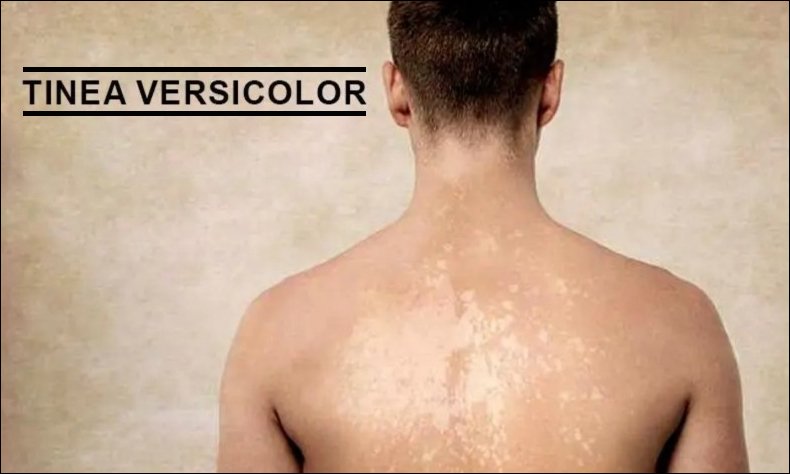 Tinea Versicolor or An-An: Types, Causes, Prevention, Cure