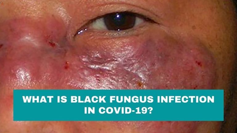 what-is-black-fungus-infection-in-covid-19