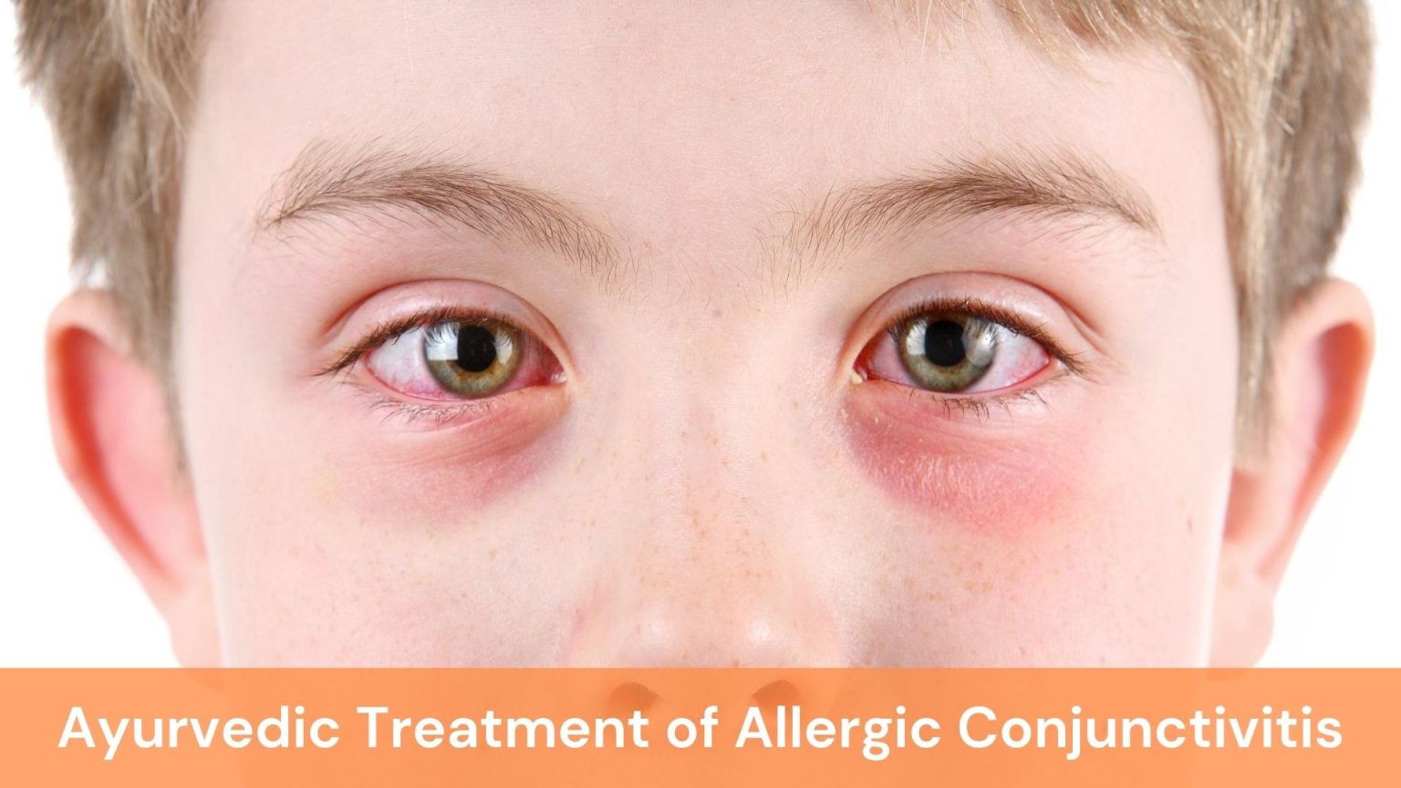 Allergic Conjunctivitis Causes Symptoms And Ayurvedic Treatment 