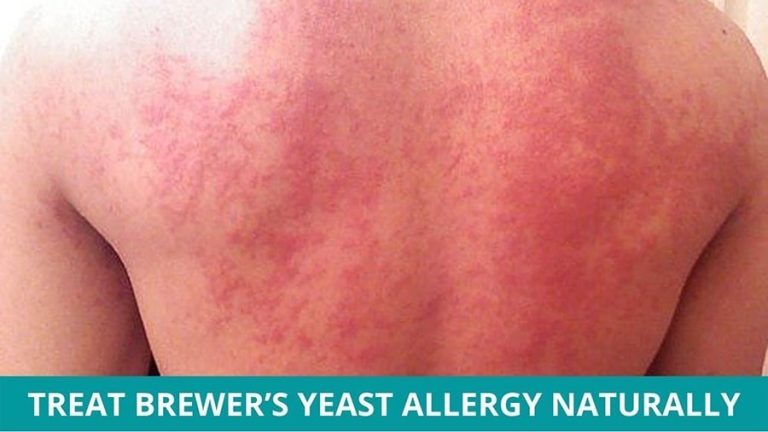 How to Treat Brewer’s Yeast Allergy Naturally?