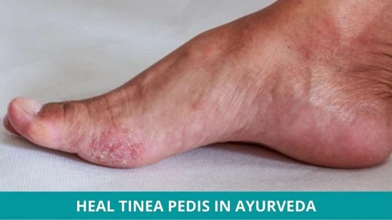 Foot Tinea Natural Treatment