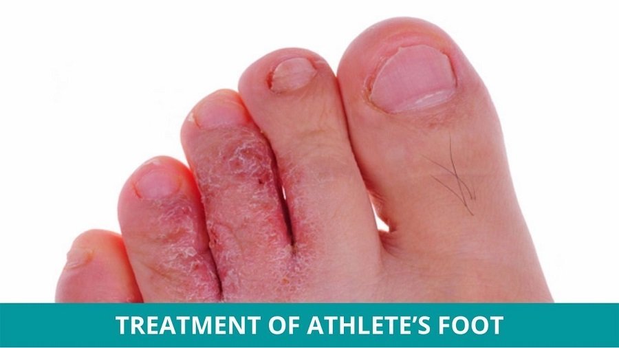 Types of Foot Fungus and Bacterial Infections