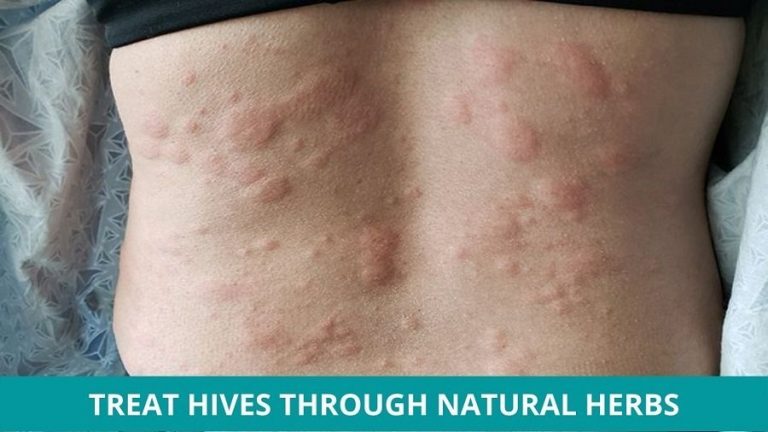 how-to-treat-hives-through-natural-herbs