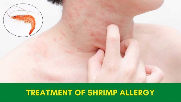 Treatment Of Shrimp Allergy In Ayurveda - Safe And Natural