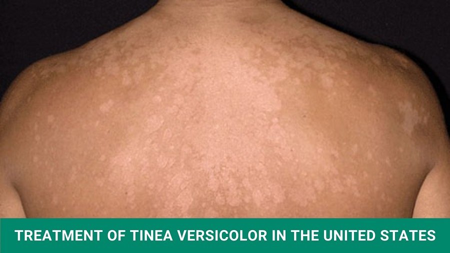 What is Tinea Versicolor?