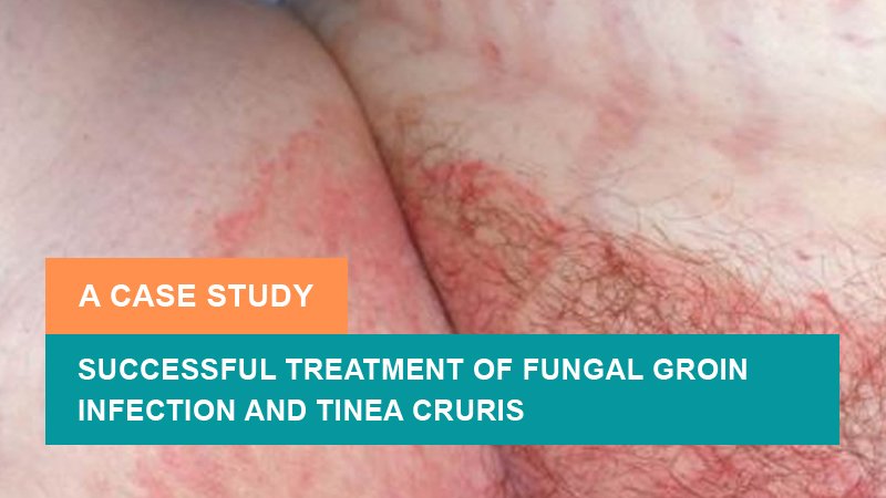 Successful Treatment of Fungal Groin Infection and Tinea Cruris