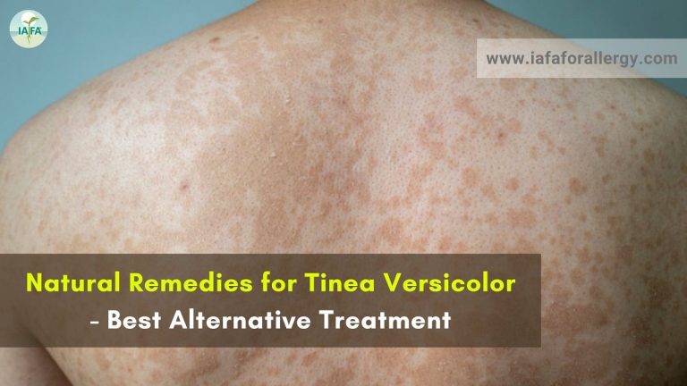 Natural Remedies For Tinea Versicolor - Best Alternative Treatment