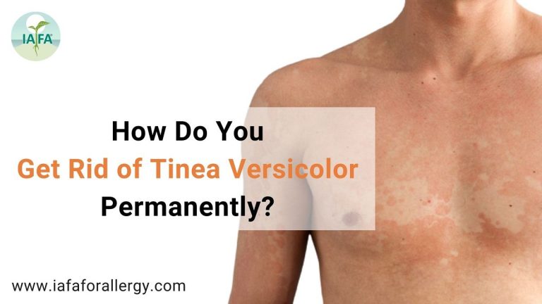 How Do You Get Rid of Tinea Versicolor Permanently?