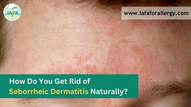 How Do You Get Rid Of Seborrheic Dermatitis Naturally?