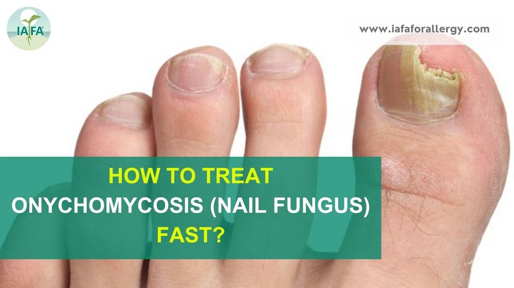 Nail fungus | informedhealth.org
