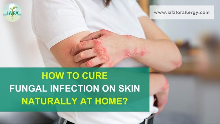 How To Cure Fungal Infection On Skin Naturally At Home