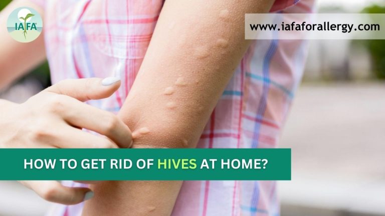 Hive Treatment At Home Complete Guidance 2382