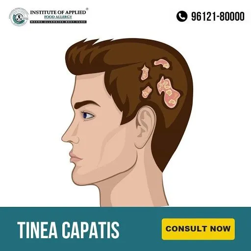 Tinea Capitis (Ringworm of the Scalp)