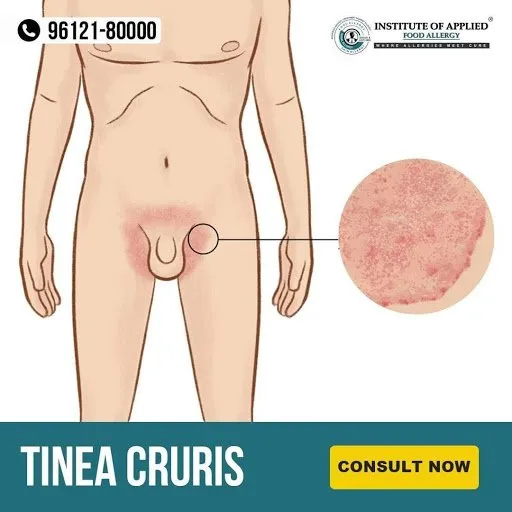 Tinea Cruris (Jock Itch)
