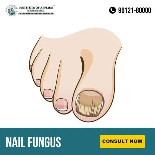 Tinea Unguium (Nail Fungus)