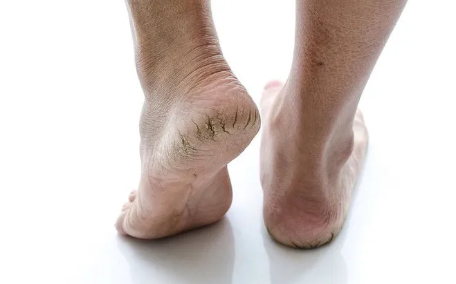 What Really Causes Cracked Heels—and How to Get Rid of Them | Reader's  Digest