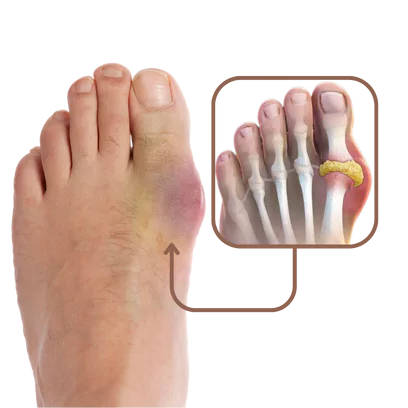 Gout - Causes, Symptoms and Treatment