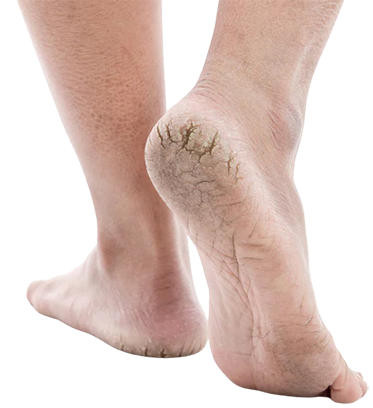 Dry Cracked Heels - Bruyere Foot Specialists