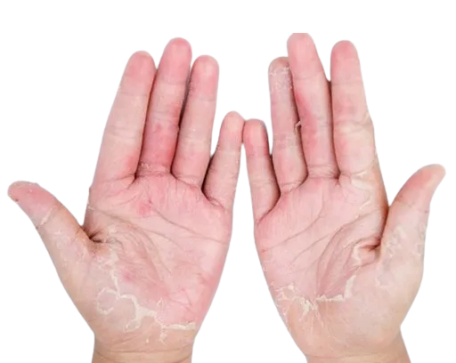 Ayurvedic Treatment for Latex Allergy - A Comprehensive Guide