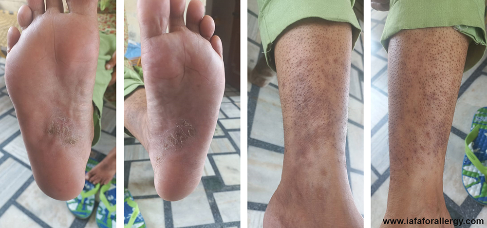 Successful Treatment of Dyshidrotic Eczema and Onychomycosis - A Case Study