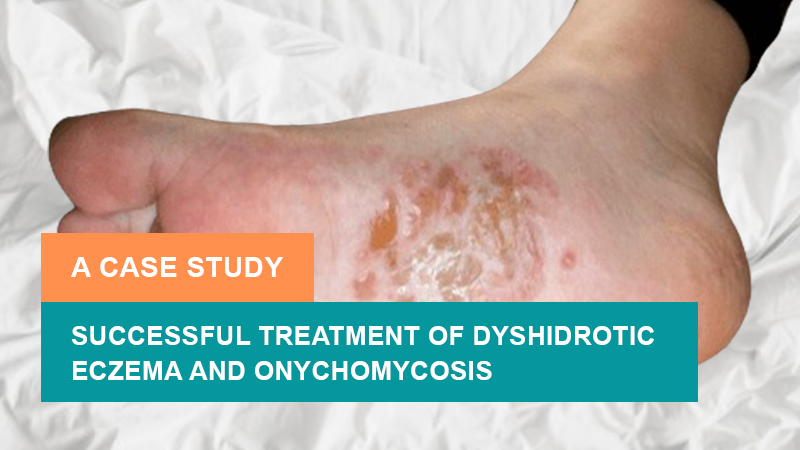 Successful Treatment of Dyshidrotic Eczema and Onychomycosis – A Case Study