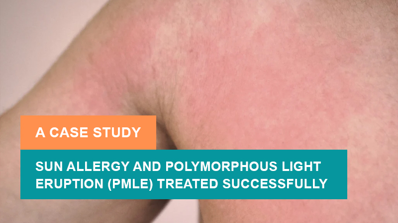 Sun Allergy and Polymorphous Light Eruption (PMLE) Treated Successfully - A Case Study